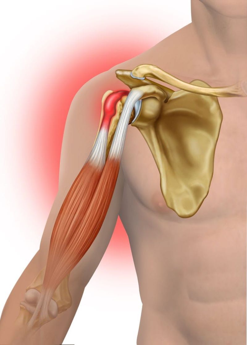 Lesi N Del Tend N Del B Ceps S Ntomas Diagn Stico Y Tratamiento Blog Cl Nica Privada Jaime I