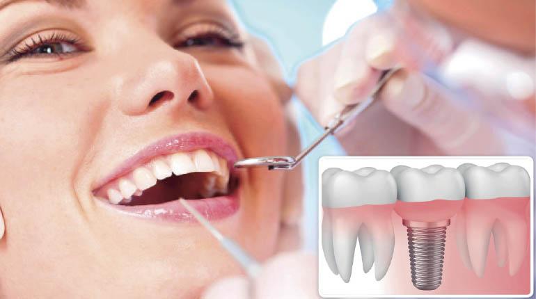implantes dentales clinica jaimei catarroja