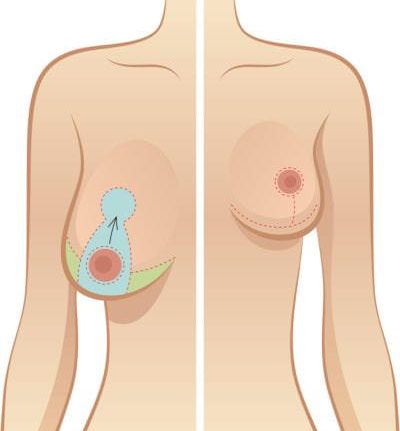 Cirugía estética de reducción de senos