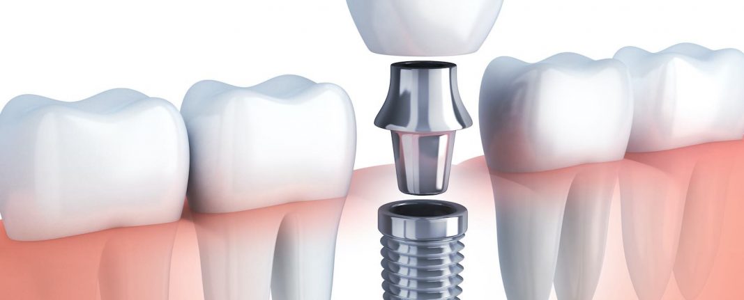 implante dental catarroja