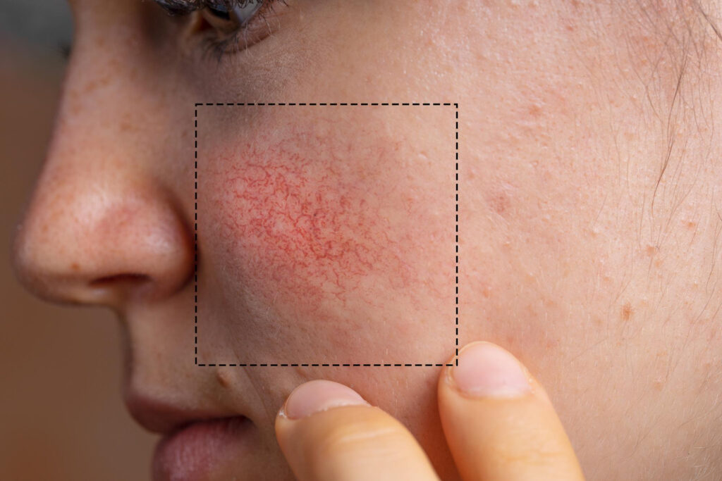 El-cloro-la piel-el acné-valencia