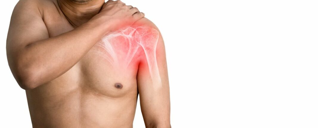 artrosis de hombro