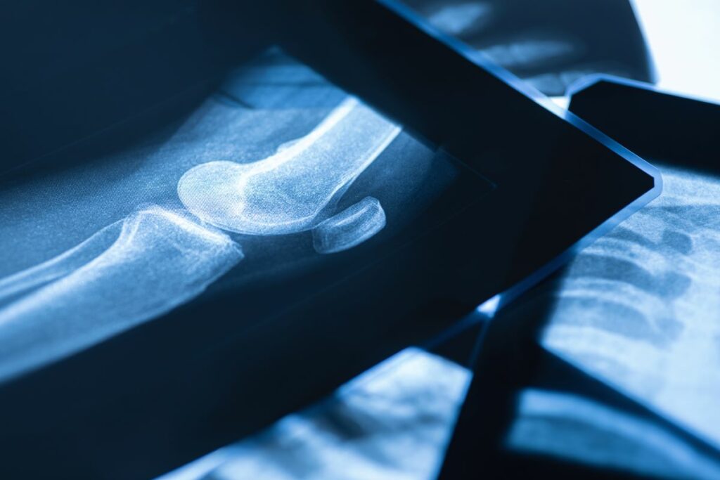 Bursitis de rodilla: Síntomas, causas y tratamientos