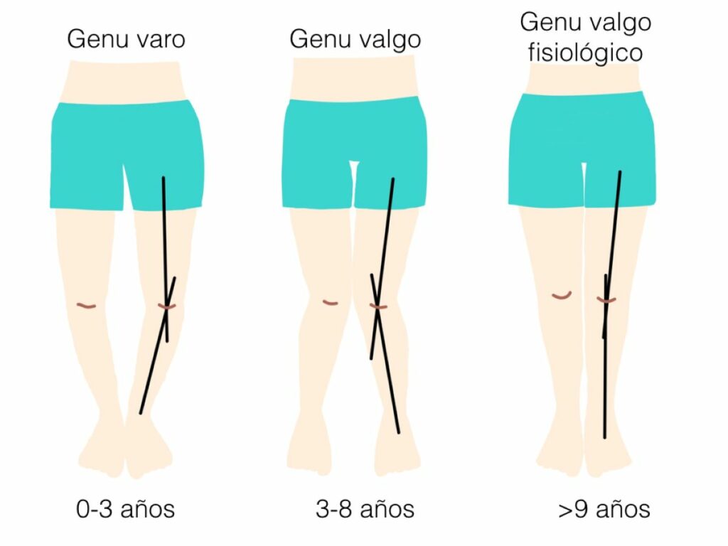 Genu varo: causas, síntomas y tratamientos para corregir esta desalineación de las rodillas