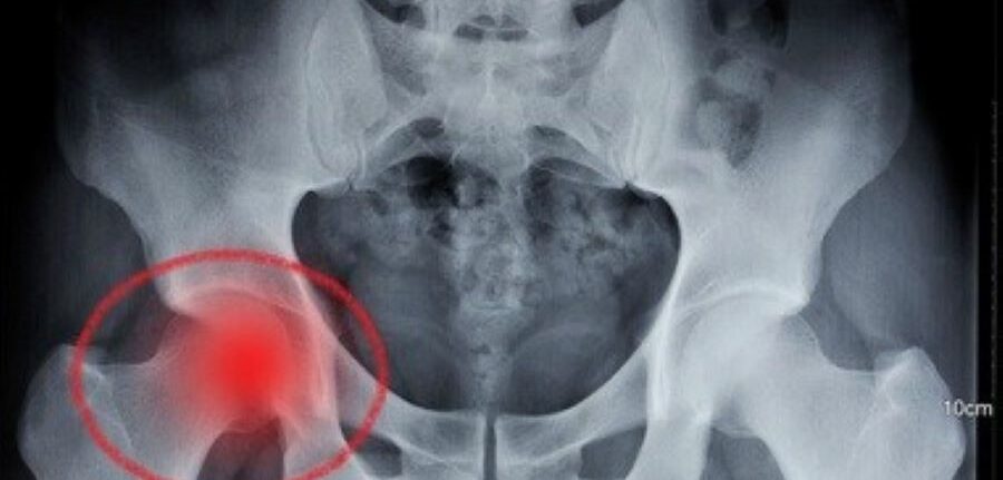 Trocanteritis: causas, síntomas y tratamiento para aliviar el dolor en la cadera