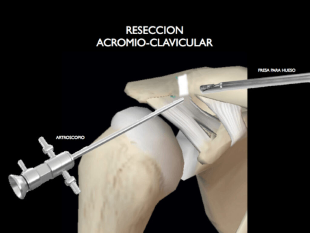  artrosis-acromioclavicular-valencia