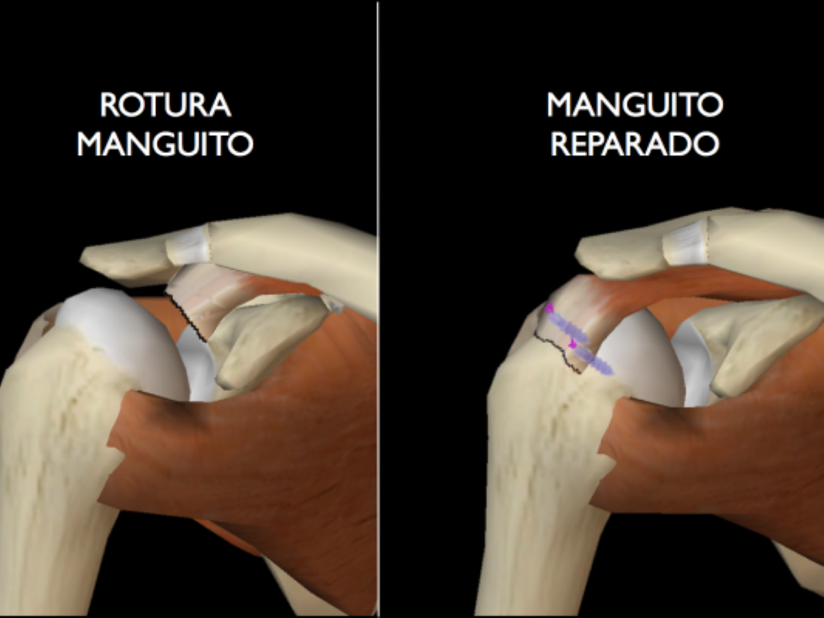 Rotura del manguito rotador causas síntomas y tratamiento Blog Clínica Privada Jaime I