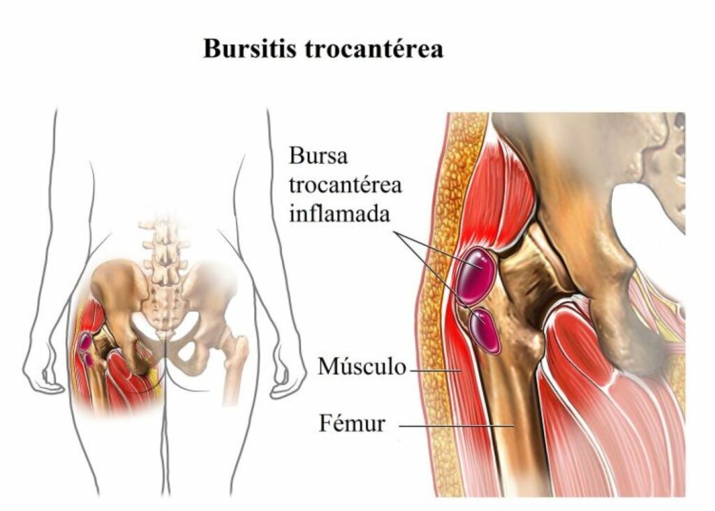 Bursitis trocanterica: causas, síntomas y tratamiento en la cadera