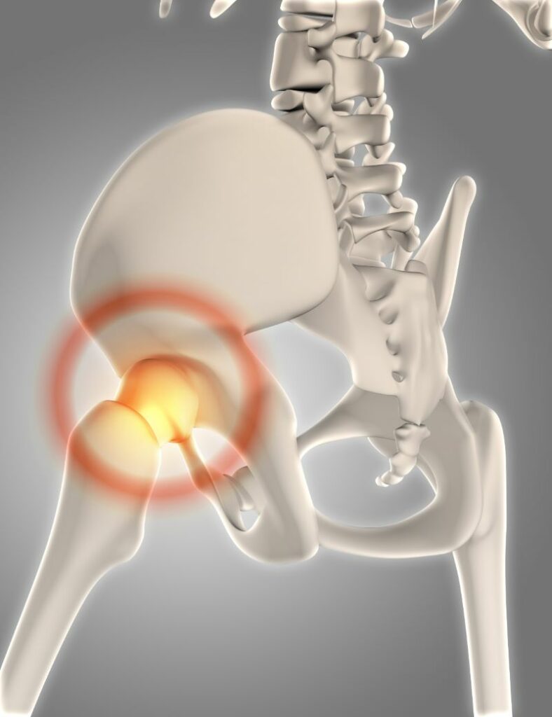 tendinitis-de-cadera-en-valencia