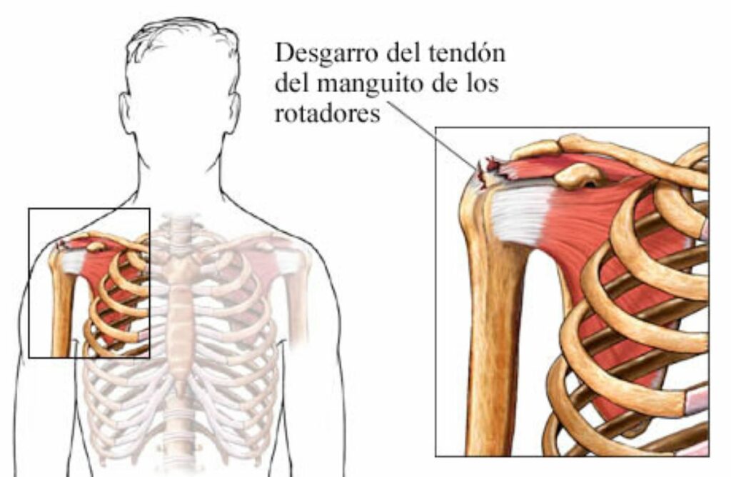 rotura-del-manguito-rotador