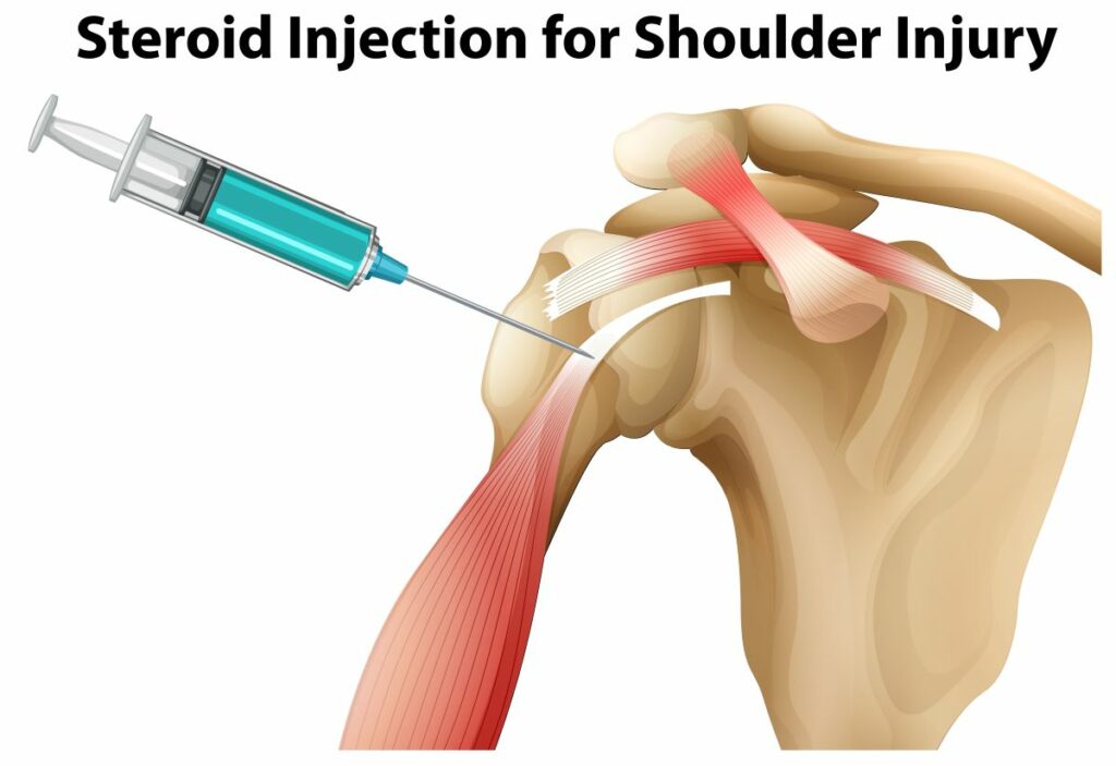 bursitis en el hombro