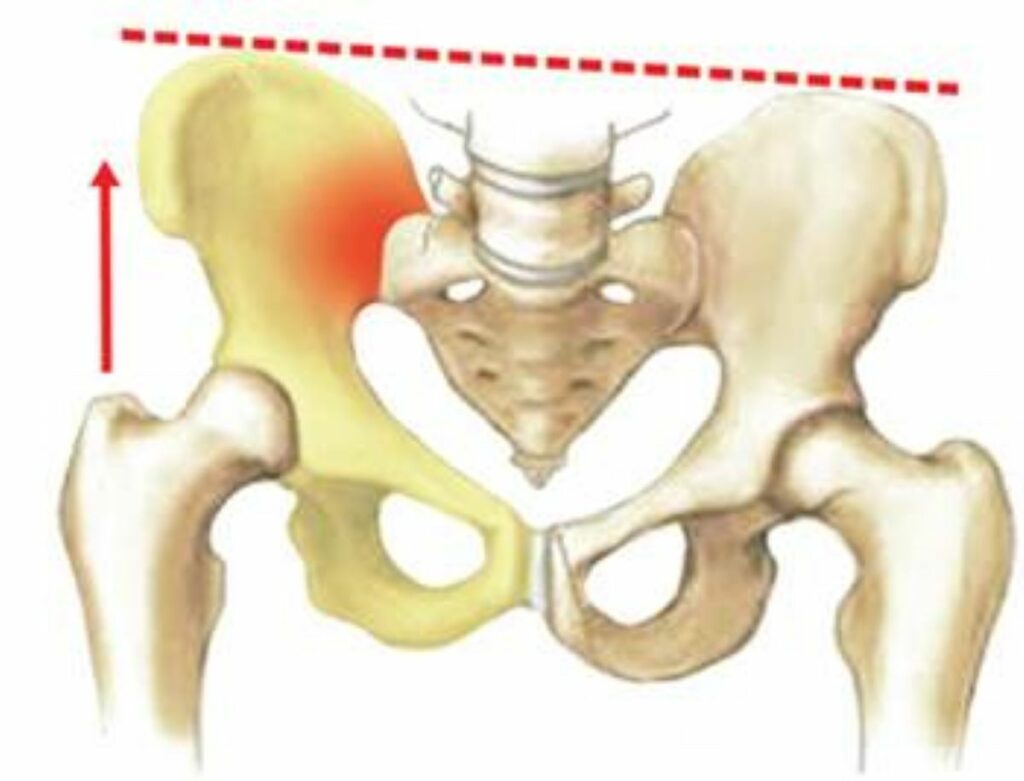 Sacroileitis: Causas, síntomas y tratamiento de esta enfermedad dolorosa