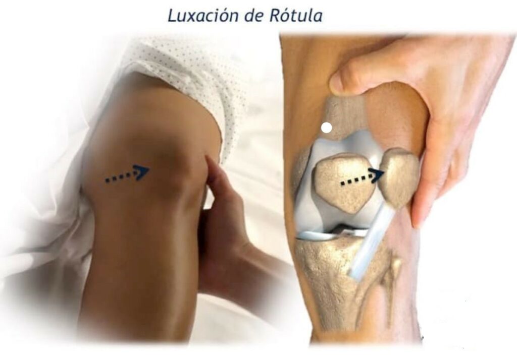 Luxación de rótula en la rodilla: causas, síntomas y tratamiento