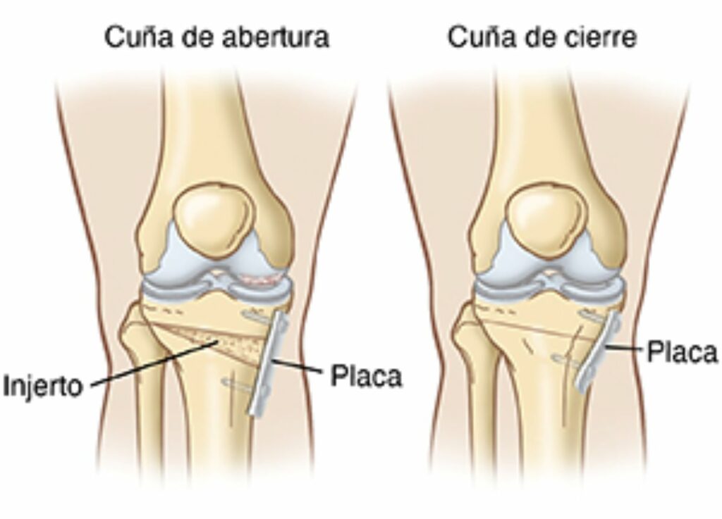 genu-valgo-valencia