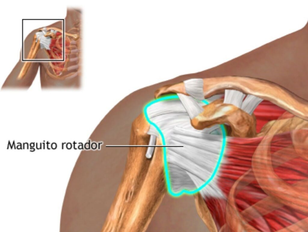 rotura-del-manguito-rotador