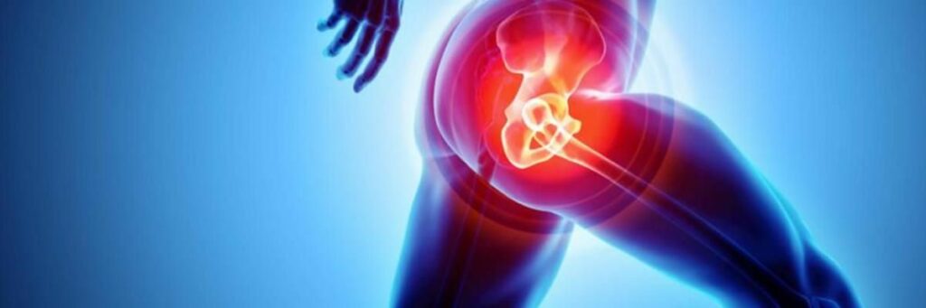 Trocanteritis: causas, síntomas y tratamiento para aliviar el dolor en la cadera