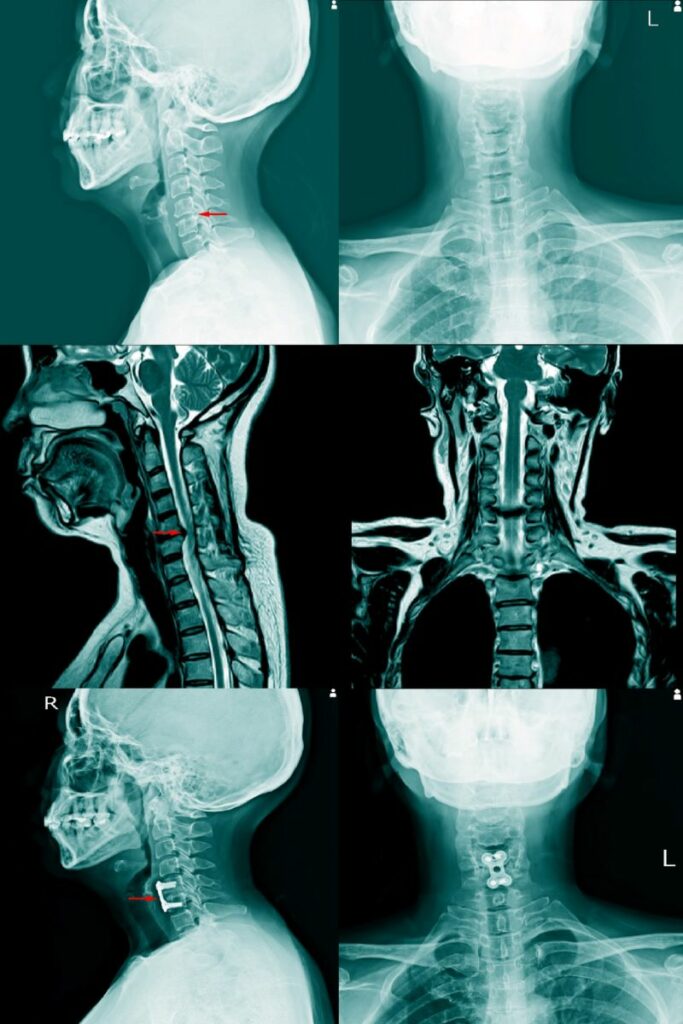 dolor-cervical-valencia