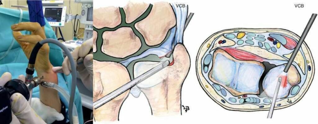 rotura-del-fibrocartílago-triangular