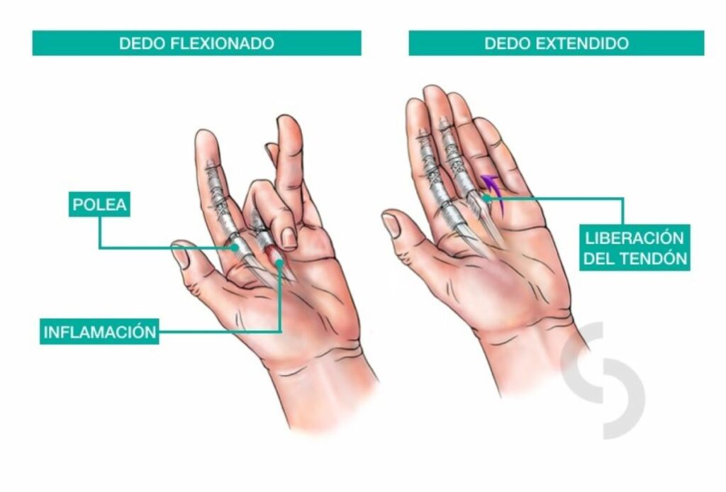 dedo-en-resorte, dedo-en-gatillo, tenosinovitis-estenosante-digital