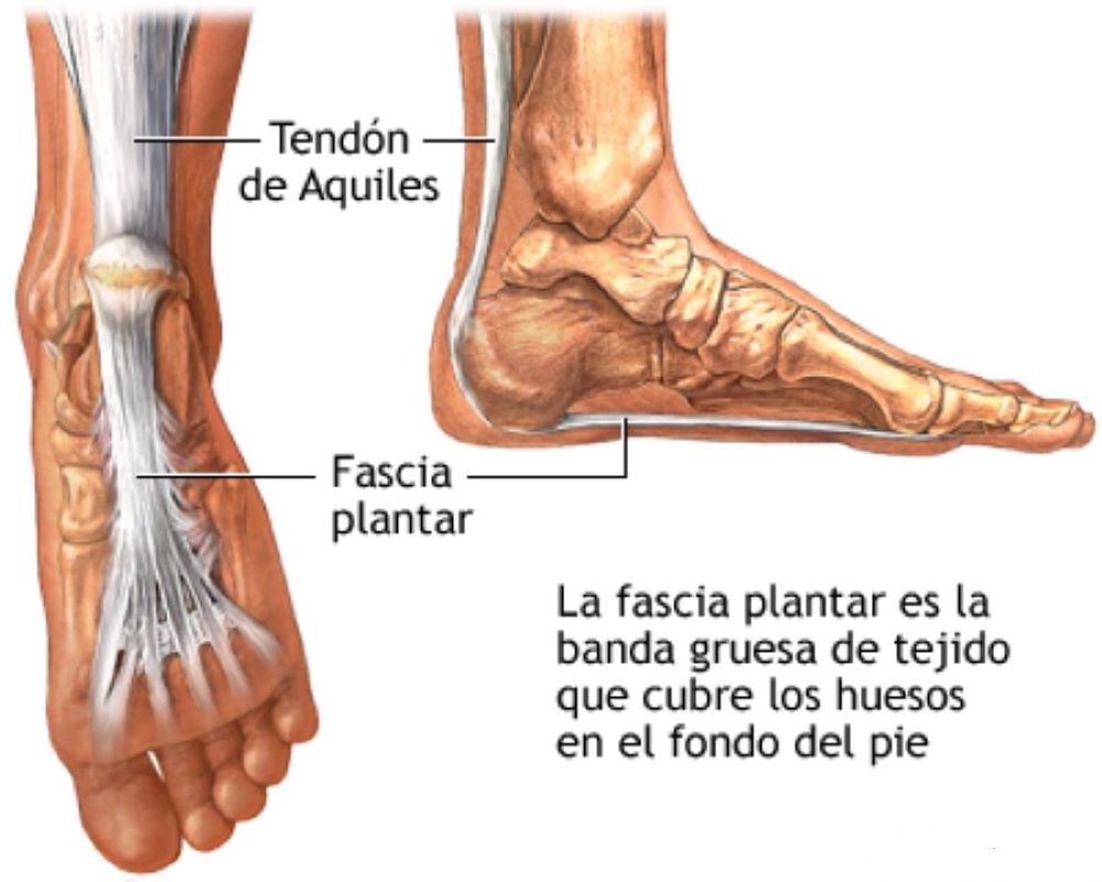 Fascitis Plantar: Síntomas, tratamiento y prevención