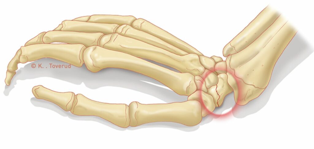 fractura-de-escafoides-valencia