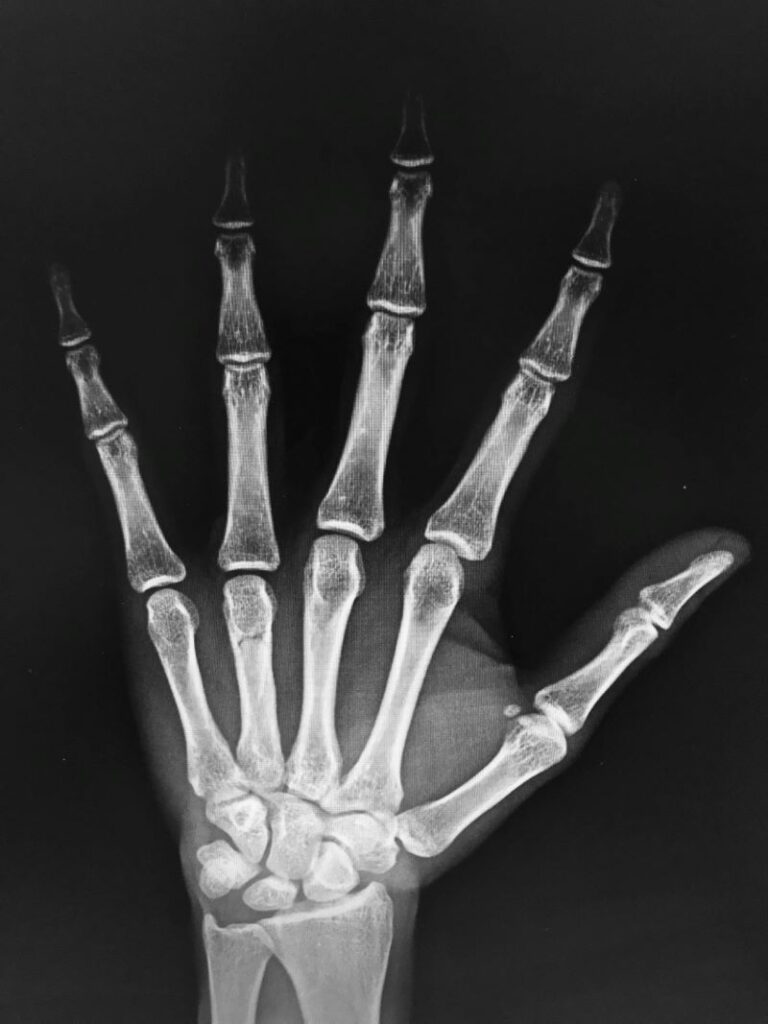 artrosis-de-manos-valencia