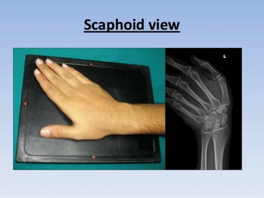 fractura-de-escafoides