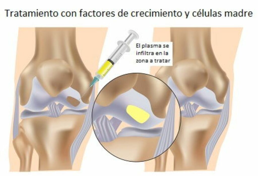 células-madre-en-la-regeneración-de-rodilla