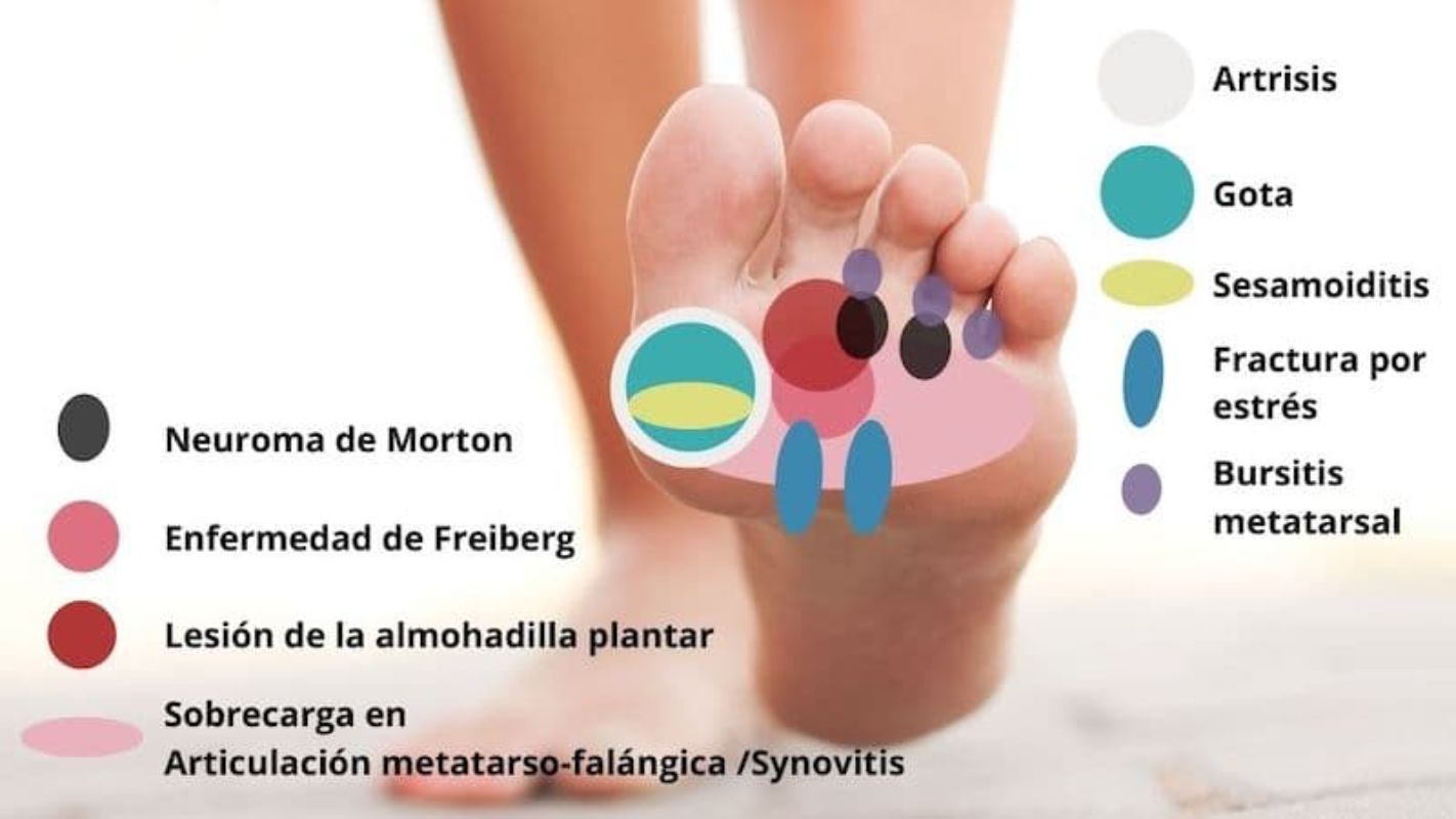 Dolor De Planta Del Pie Causas S ntomas Y Tratamiento Traumatolog a