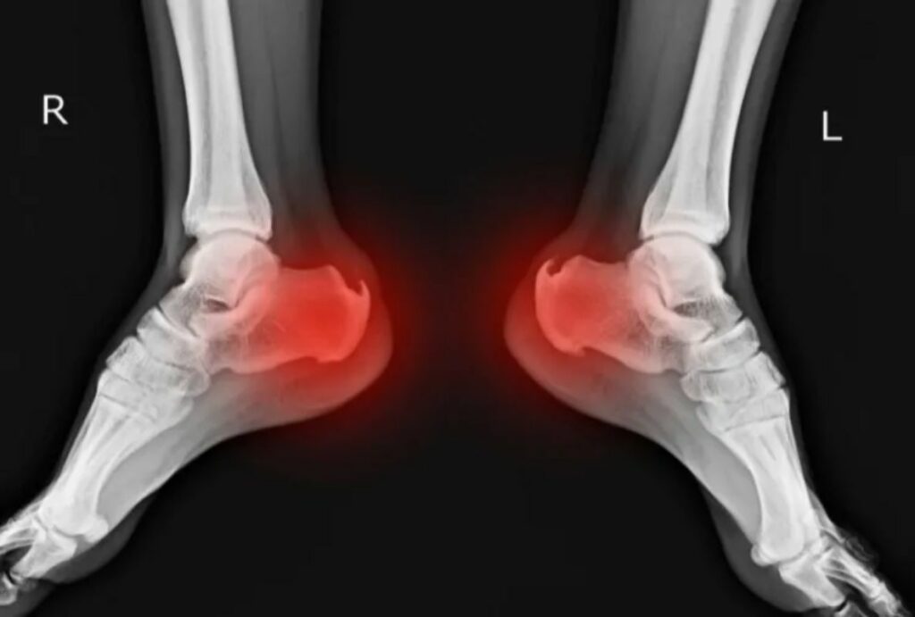 Espolón calcáneo del pie: causas, síntomas y tratamientos
