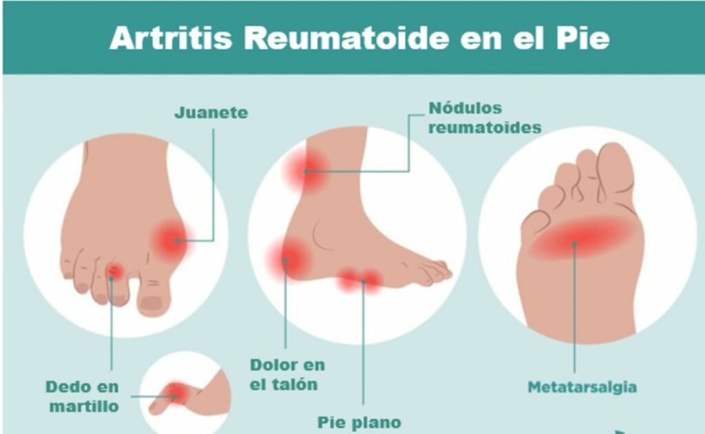 artritis-del-pie-valencia