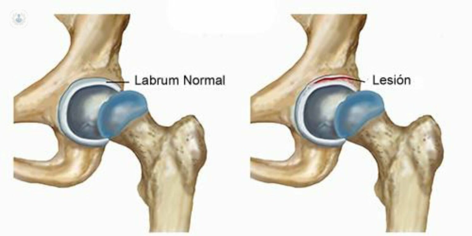 Labrum Hour Desgarros en el labrum de la cadera: Causas, síntomas y tratamiento en ...