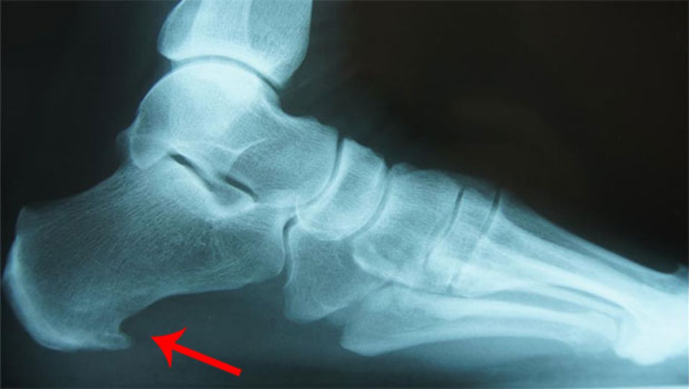 Espolón calcáneo del pie: causas, síntomas y tratamientos | Traumatología