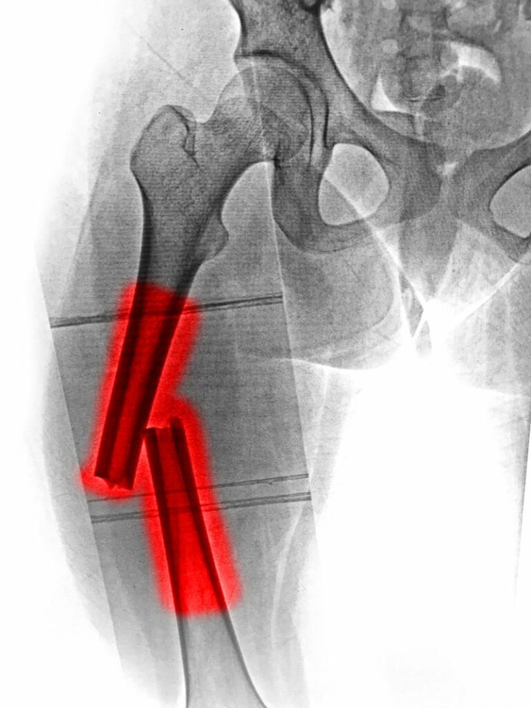 osteoporosis-valencia