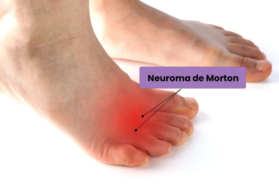 Neuroma de Morton: Causas síntomas y tratamiento para aliviar el dolor Neuroma de Morton: Causas síntomas y tratamiento para aliviar el dolor