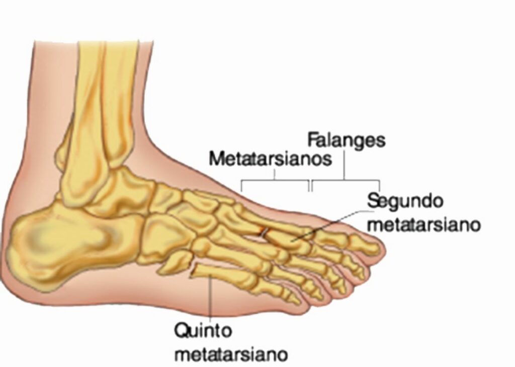 Metatarsalgia Del Pie Causas S ntomas Y Tratamiento De Esta Dolencia 