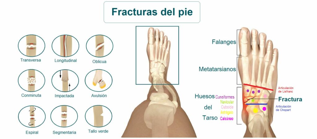Fractura del pie: causas, síntomas y tratamiento en profundidad