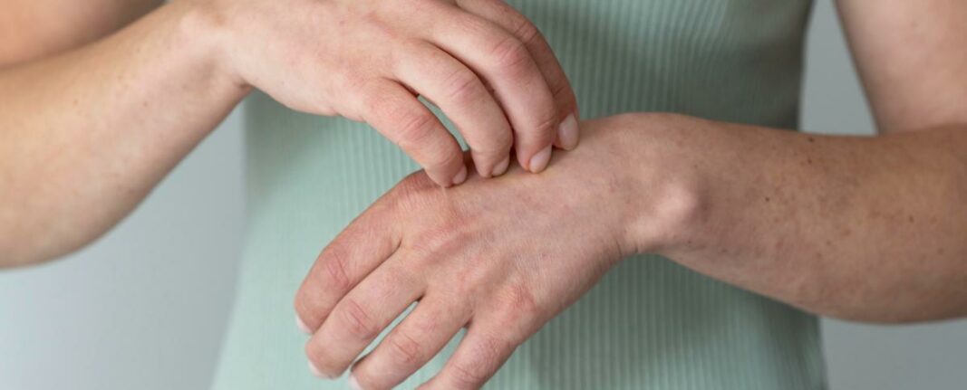 Artritis por lupus: sintomatología, diagnóstico y tratamiento en España