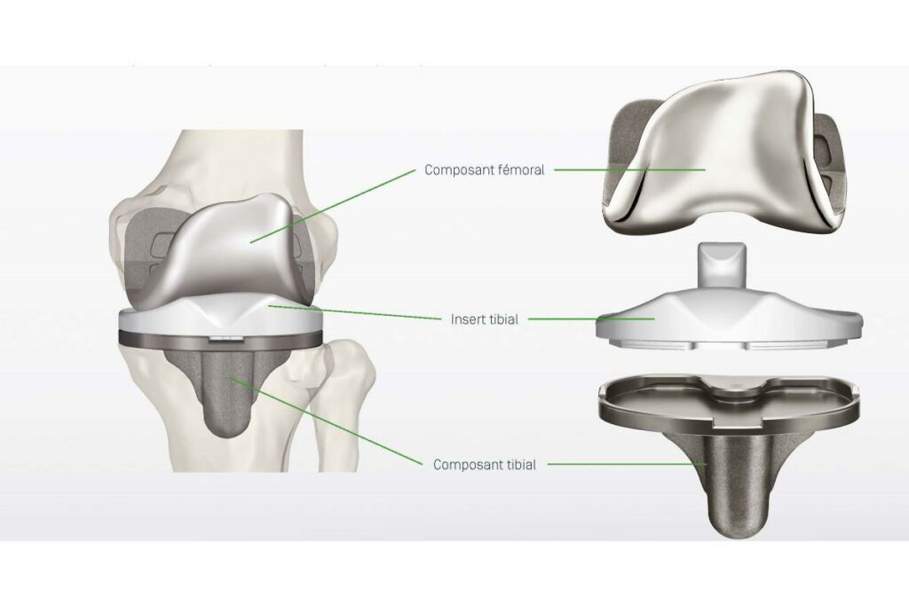 Prótesis de rodilla