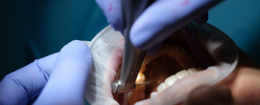 Regeneración ósea: Todo sobre los implantes dentales y cómo ayudan a tus huesos