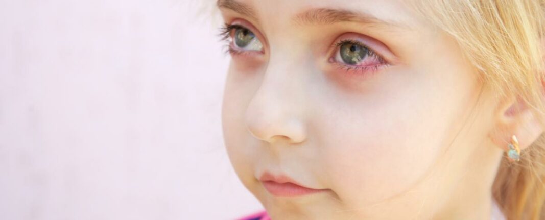 Conjuntivitis en niños: Causas, síntomas y tratamiento