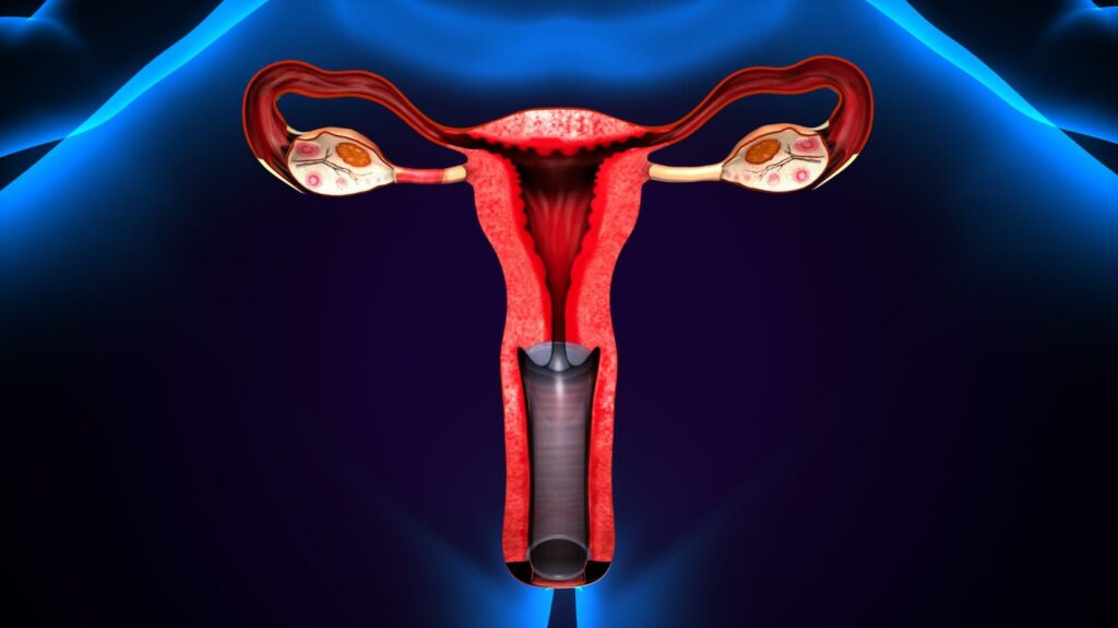  endometriosis-valencia