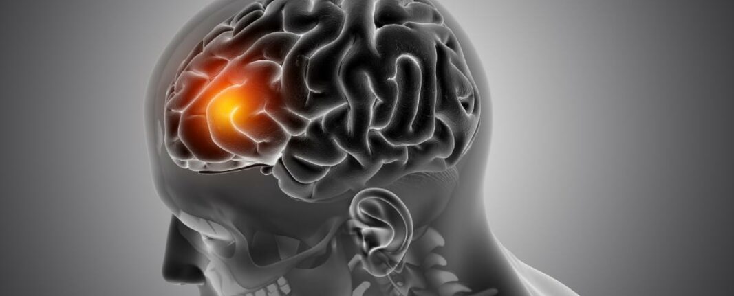 Accidente cerebrovascular: Importancia de contar con especialistas y pruebas diagnósticas