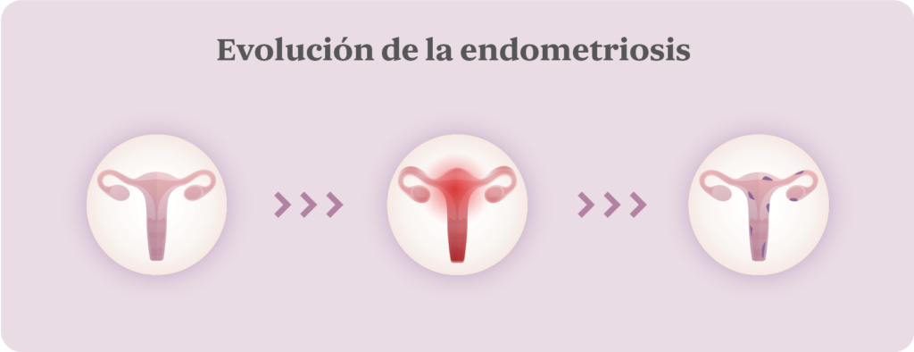 Evolucion-de-la-endometriosis