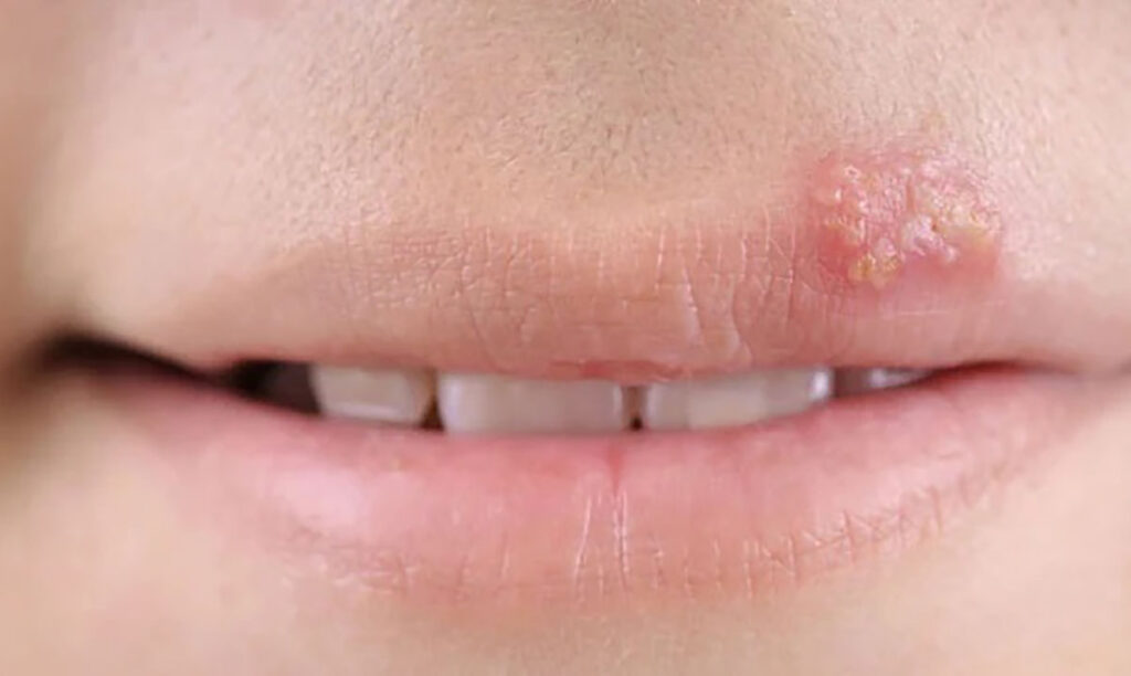 herpes-labial