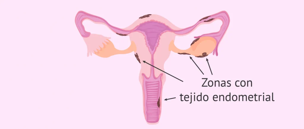 localizacion-implantes-de-endometriosis.png