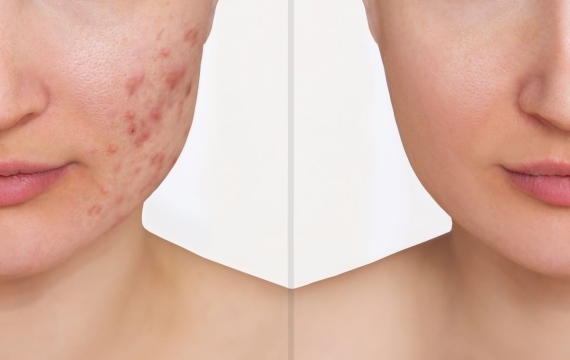 tratamiento acné en Valencia tratamiento acné en Valencia