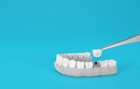 implantologia-valencia