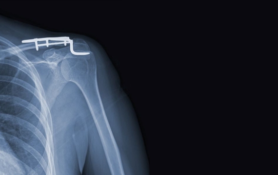 tipos-de-fijaciones-hombro