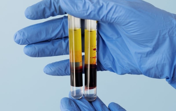 plasma rico en plaquetas